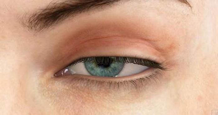 افتادگی پلک: علل، نشانه‌ها و راهکارهای درمان