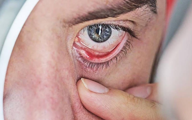 خشکی چشم را بشناسید؛ روش‌های پیشگیری و درمان موثر